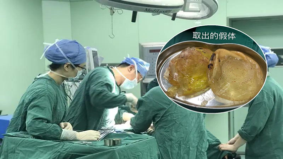 女子30年前隆胸的假体破裂 渗液喷射而出
