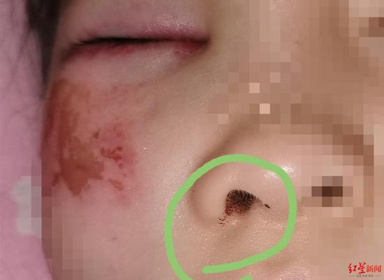 母亲发现孩子鼻孔中也有血迹
