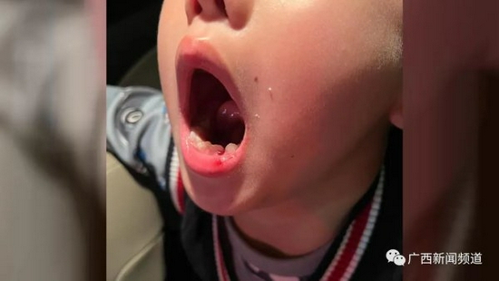广西南宁6岁男童被钢琴老师扇掉一颗牙，老师：正常教学而已
