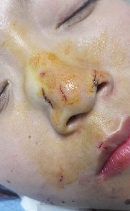 女游客泰国亲吻毒蛇被咬住鼻子 血流满面