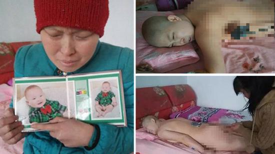 实拍:女子用烙铁“烫”癌细胞