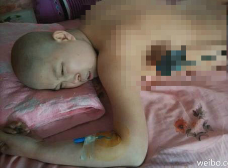 女子无钱治白血病欲用烙铁烫癌细胞遭质疑