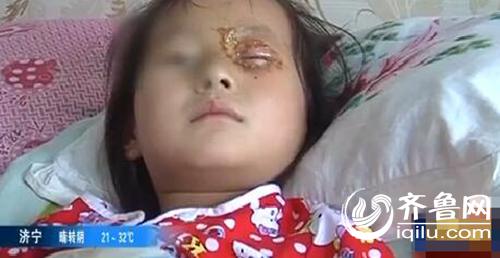 6岁女童被生日蛋糕上的音乐蜡烛炸伤了眼睛，眼角膜烫伤。