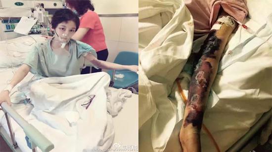 徐婷医院接受治疗