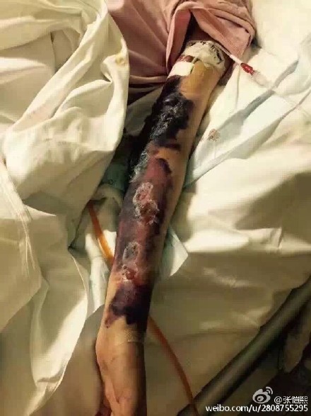 徐婷医院接受治疗