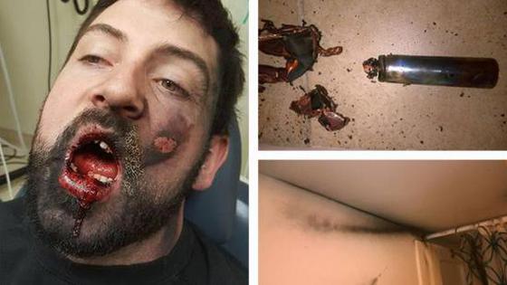 男子吸电子烟突然爆炸