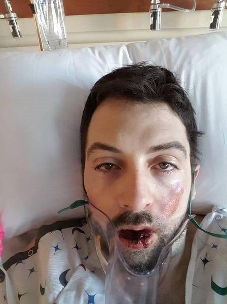 男子吸电子烟突然爆炸