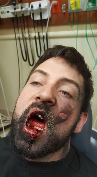 男子吸电子烟突然爆炸