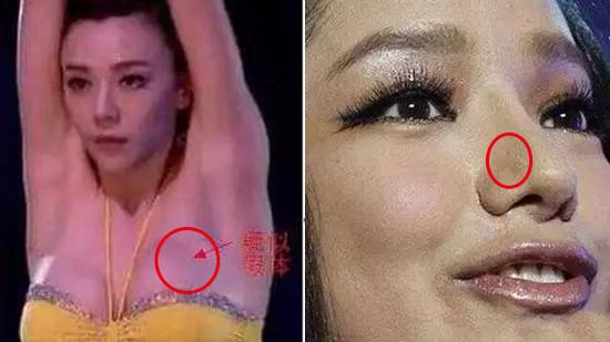 图揭明星手术刀口位置，看得我整个人都不好了