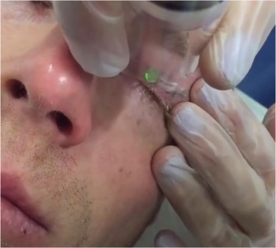 后来终于找到一家可以激光祛除纹身的店，纹过身的人都知道，洗纹身是非常疼的，更可况是在眼睛这么敏感的地方。