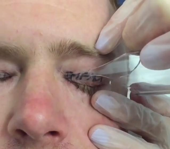 疼痛让他泪流不止，鼻头红肿，而且被激光烧过的地方，能明显看到被灼伤的皮肤，估计他要休养一段时间才能好