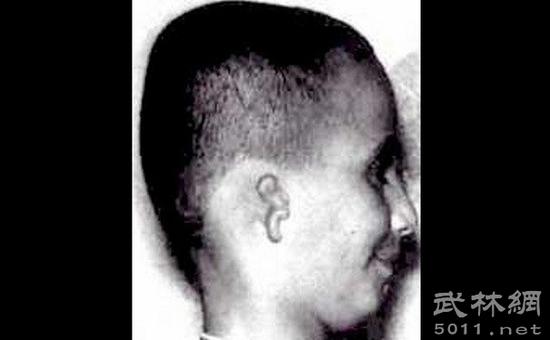 一名土耳其猎人因为枪走火，导致头盖骨被炸裂，当场死亡。6天后，当地医院出生一位畸形儿，他不但右侧小耳畸形，同时面颊凹陷，根据数据分析，生出此种畸形儿的机率小于6千分之1。