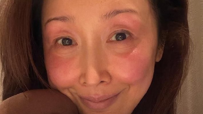 孙悦自曝录春晚被冻伤，满脸通红引网友心疼