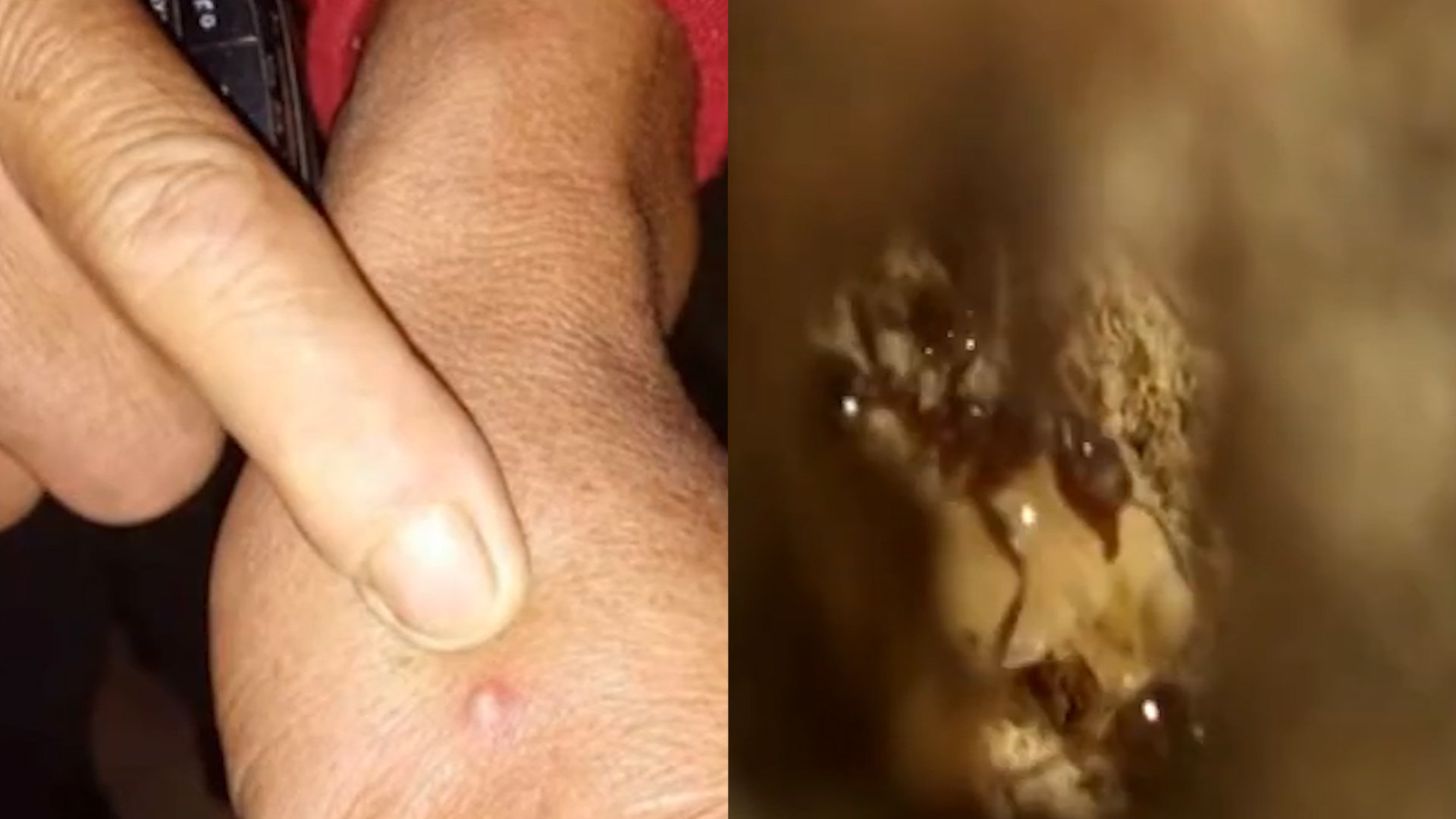 男子遭外来物种红火蚁咬后休克 医生:严重会致死