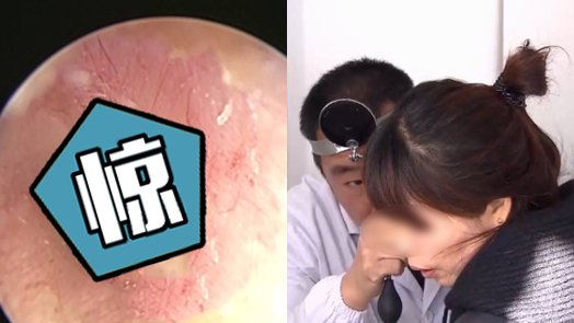 耳道钻心剧痛 医生竟夹出一只3厘米长的…