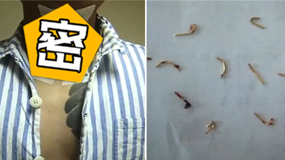 “大师”亲手植入护身符 7年后取出成这样