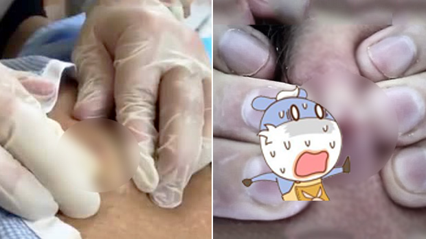 男子在镜头前挤破有20年历史的青春痘