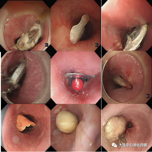 进食需谨慎谨防节日病食管异物