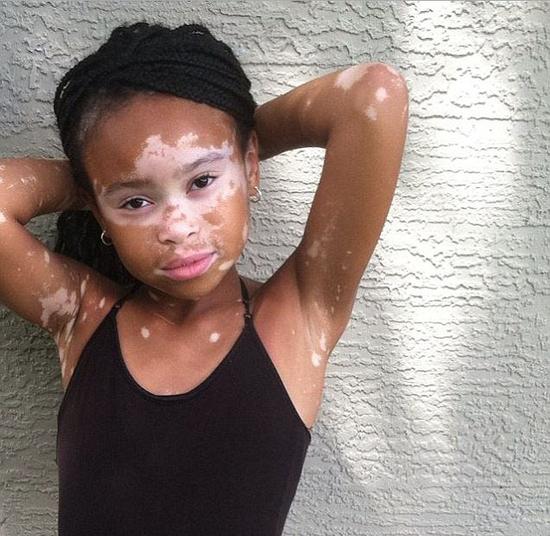 美10岁白癜风女孩为圆模特梦勇敢晒自拍照