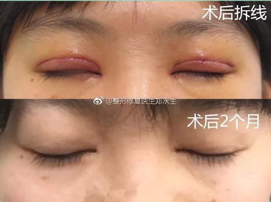 双眼皮术后1年为什么1眼就被看穿是割的