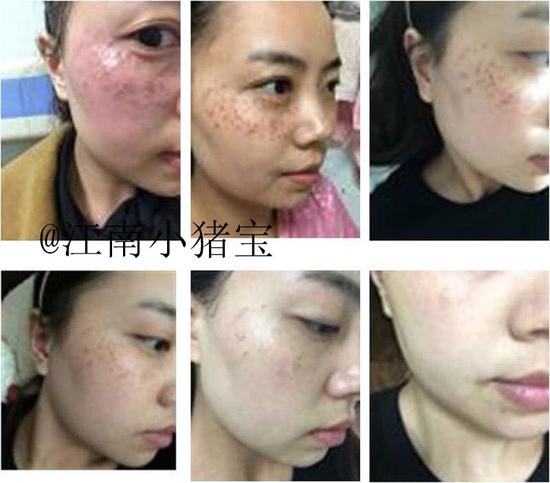 雀斑治疗后的变化过程(感谢@江南小猪宝 授权)但是对于黄褐斑患者,其