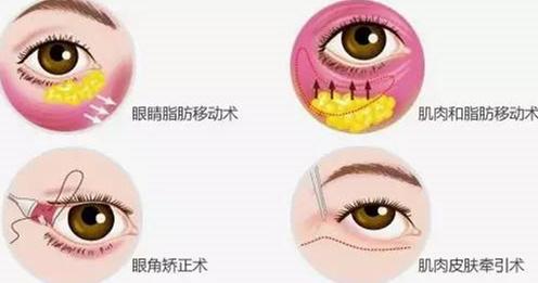 青光眼治疗：破解“视力杀手”的最新进展