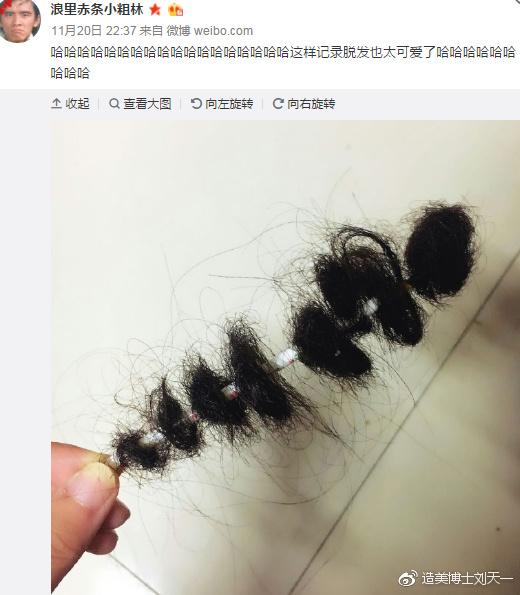 头发大把大把地掉,植发技术可以一劳永逸吗