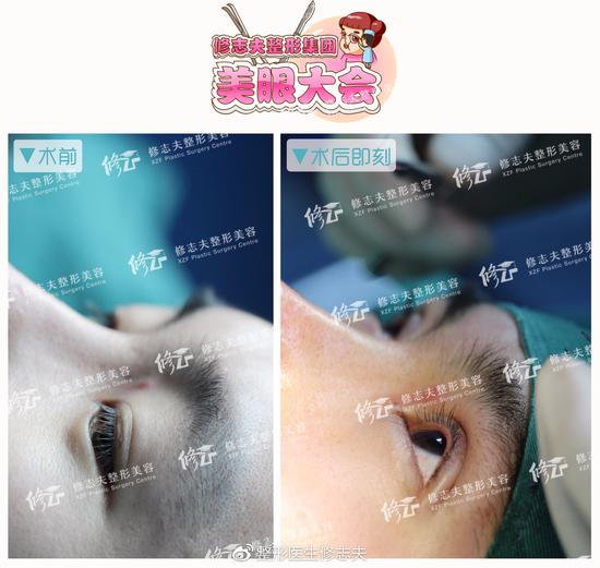 男生的双眼皮到底多宽才好看
