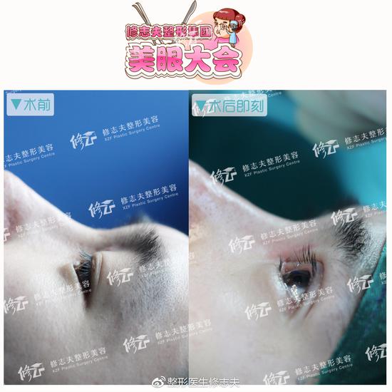 男生的双眼皮到底多宽才好看