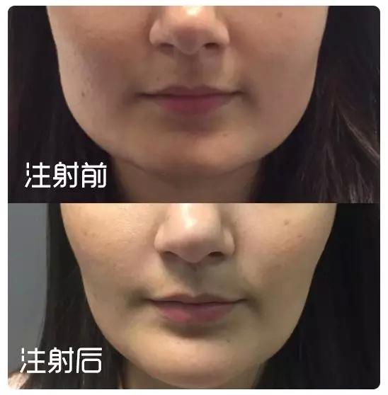 这10类人不适合打瘦脸针 究竟是啥原因|瘦脸|肉毒素|瘦脸针_新浪女性