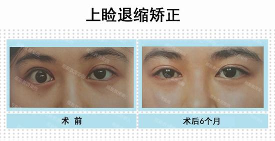术前右眼上睑下垂矫正后呈退缩体征(图左)矫正后术后6个月(图右)