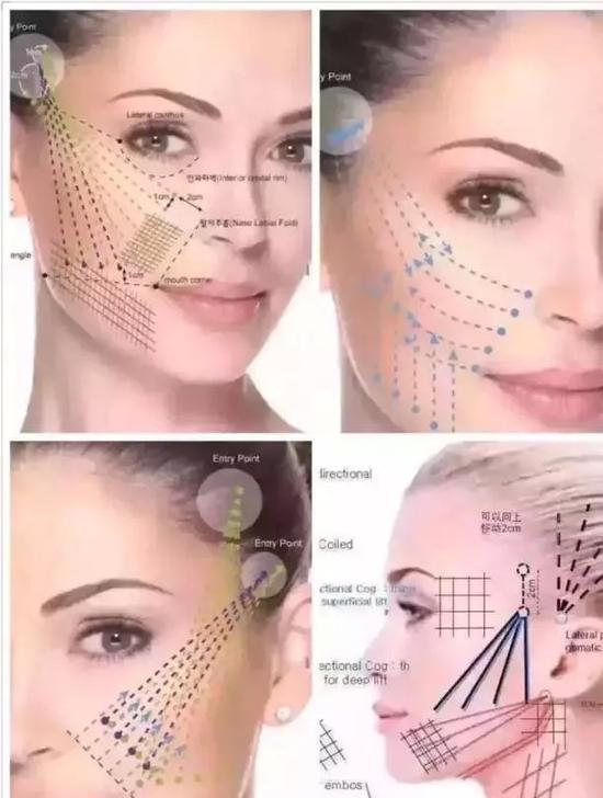 微整形已进入线雕时代关于线雕你必须知道这些