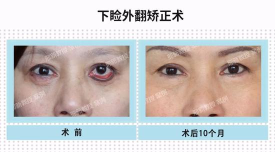 下睑外翻患者关切问题的解答|下睑|眼睑|异体_新浪女性_新浪网