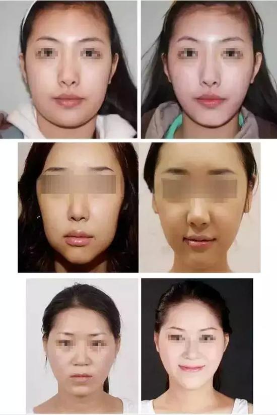 瘦脸针这样打才能瘦得快美得久