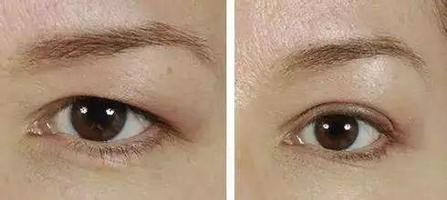 一术三效提眉术:美眉祛皱大眼|提眉|祛皱|切眉_新浪女性_新浪网