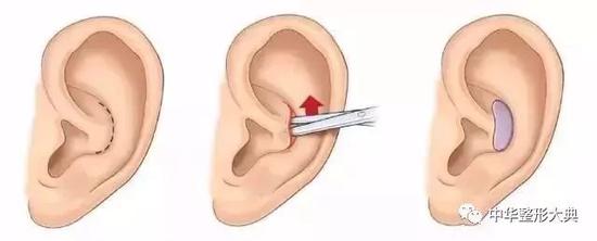 耳软骨 自体 隆鼻的7个特点 手机新浪网