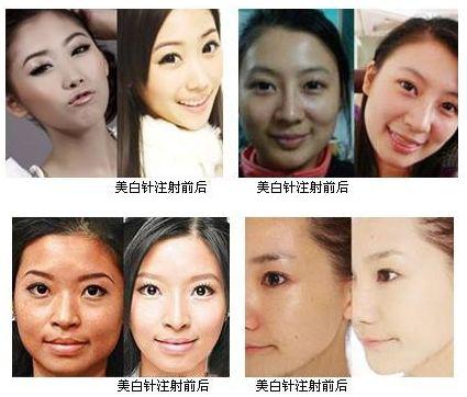 打美白针会对身体有影响吗 手机新浪网