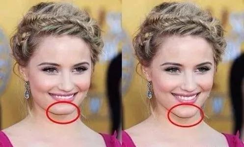 丰下巴 你适合哪种方法