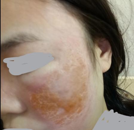 这姑娘可惨了千万不要用这个祛斑毁容没商量