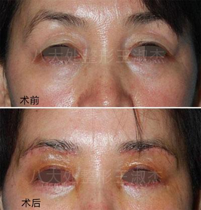 你适合哪种切眉手术方法?