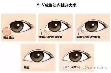 明眸指南 四种开眼角术挽救小眼睛