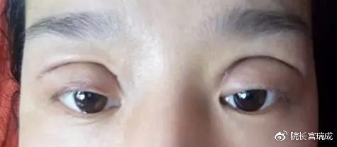 割了双眼皮还是不好看怎么办