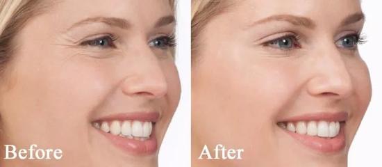 注射肉毒素祛鱼尾纹前后