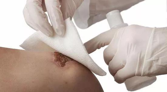 体表有伤口总是不愈合咋办