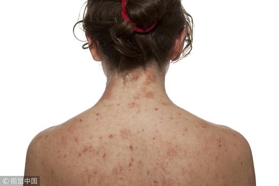 关于湿疹的你最想知道|湿疹|过敏源|检测_新浪女性_新浪网
