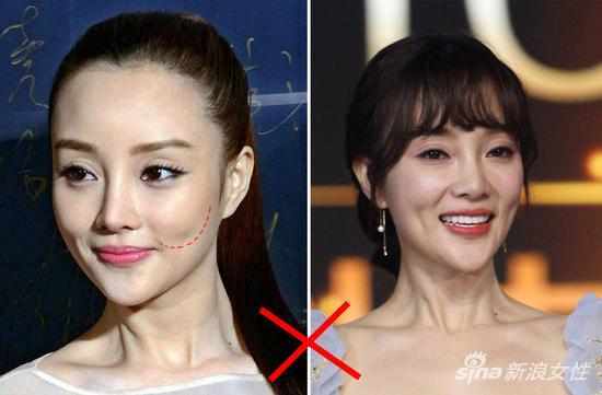 号称童颜神器的苹果肌为什么你填了却变残了