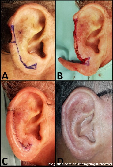 耳轮缺损修复新策略还你一个漂亮的耳朵