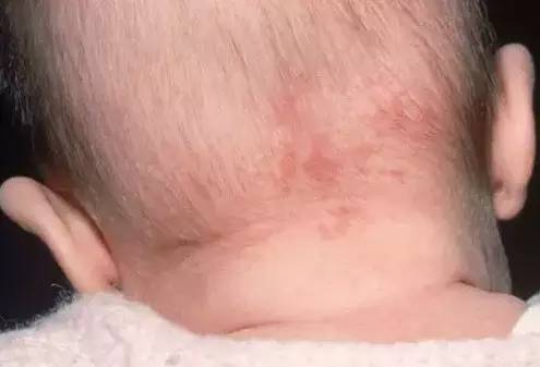 新生儿斑痣   通常为边缘不规则的粉红色或浅褐色的斑片,压之褪色
