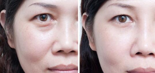 眼部泪沟形成的原因以及解决方法