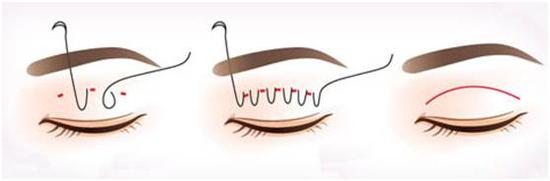 双眼皮整形手术埋线还是切开